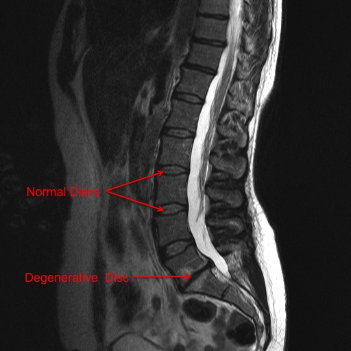 What are some symptoms of degenerative disc disease in the thoracic spine?