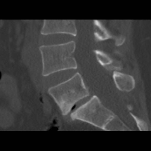 CT Showing Lytic Spondylolisthesis