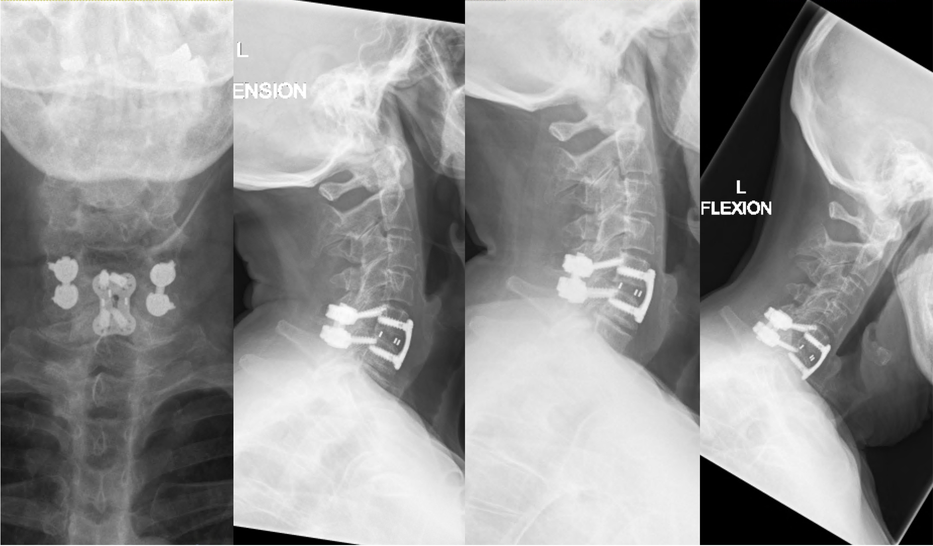 Post operative X-Rays at 6 months showing stable fixation.